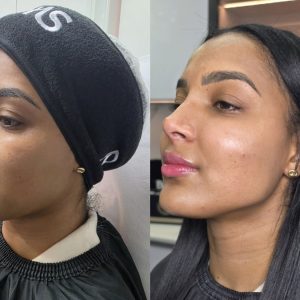 Armonización Facial Avanzada